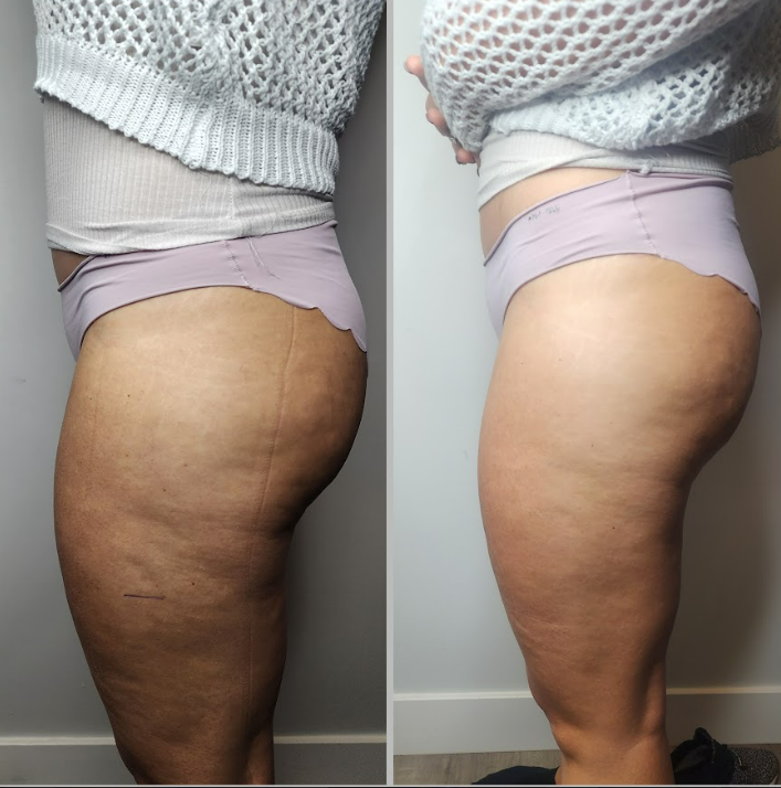 Body Sculpting Results