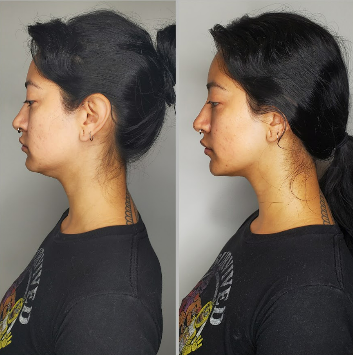 Body Sculpting Results