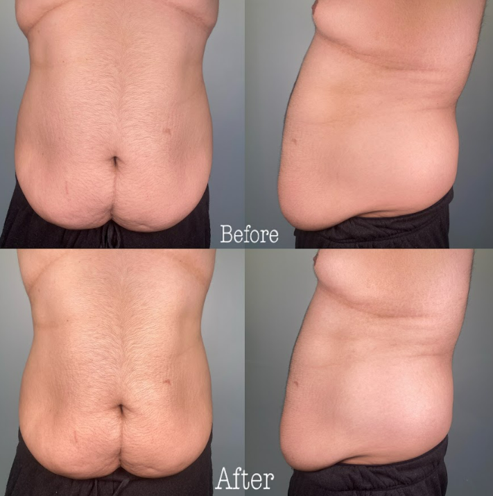 Lymphatic Drainage Results