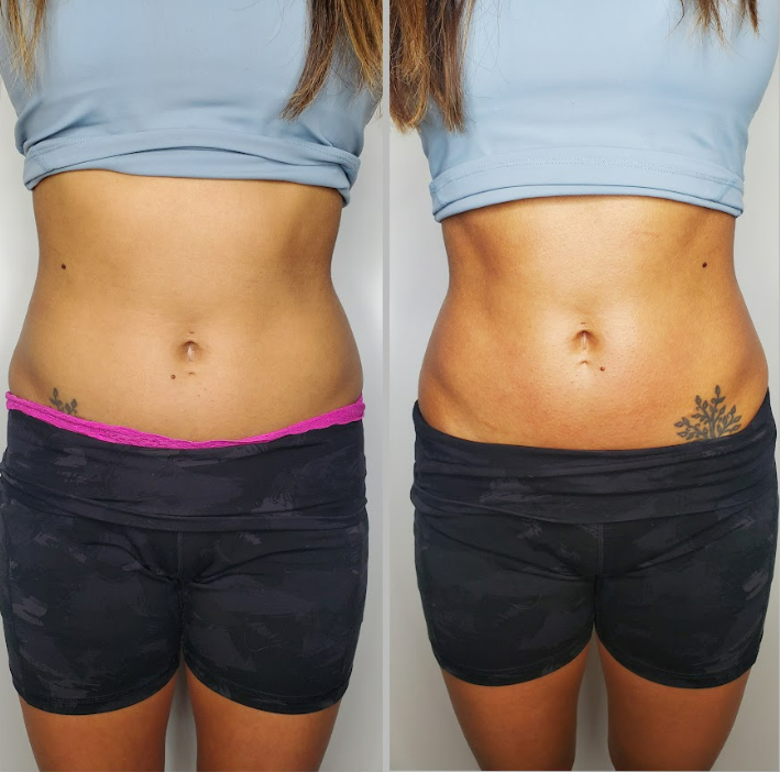 Body Sculpting Results