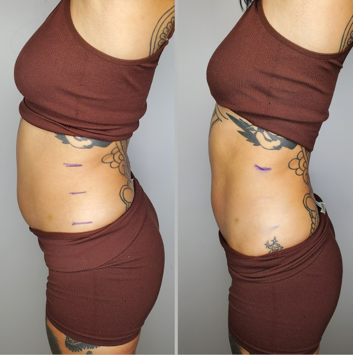 Lymphatic Drainage Results